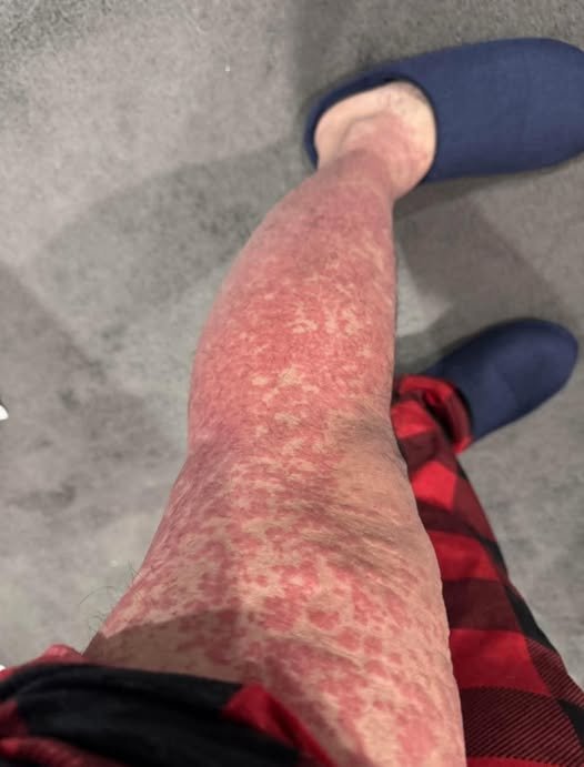 Livedo Reticularis: When Skin Patterns Tell a Deeper Story